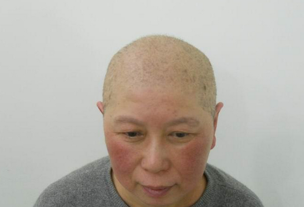 怎样预防脱发?