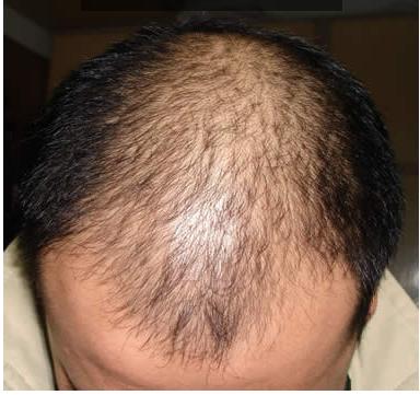 脱发患者有什么是要注意的?