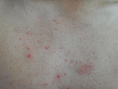 青春痘的常见治疗方法