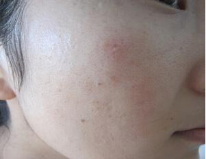 皮炎