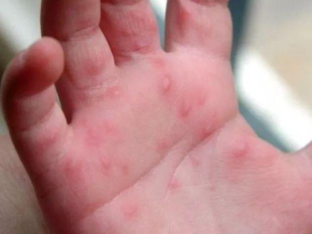水疱型手足癣的症状