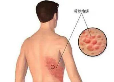 带状疱疹的症状表现及治疗方法